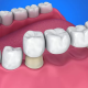 Why I Recommend Tooth Implants Over Bridges as a Dentist