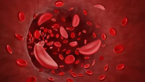 Sickle Cell Anemia Treatment