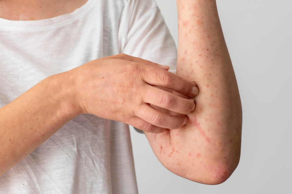 Contact Dermatitis