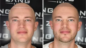 Hair Restoration: Scalp Micropigmentation