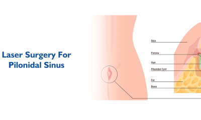 Essential Tips for Pilonidal Sinus Recovery