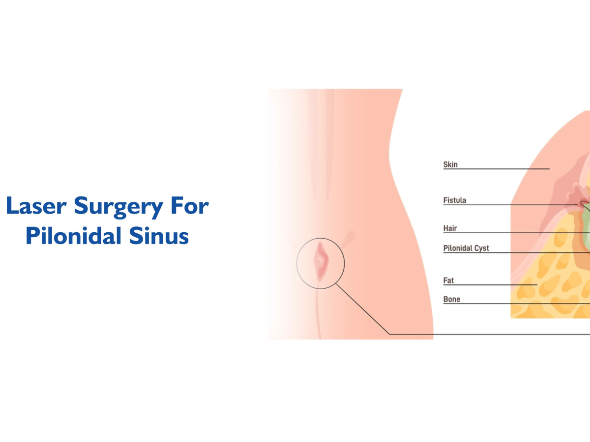 Essential Tips for Pilonidal Sinus Recovery