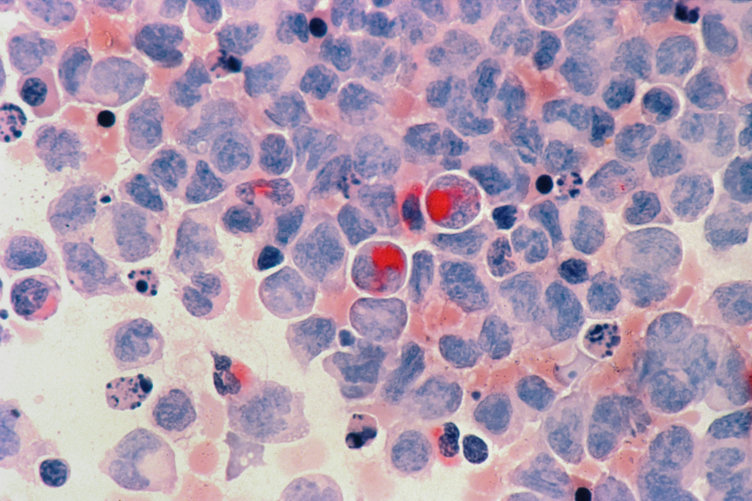 blood cancer awareness