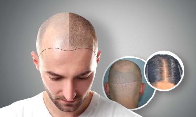 Hair Restoration: Scalp Micropigmentation
