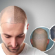 Hair Restoration: Scalp Micropigmentation