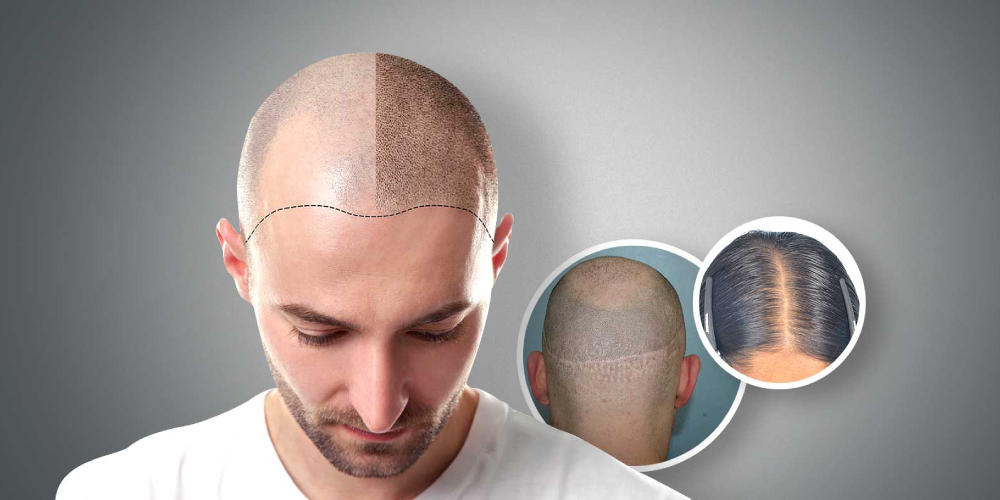 Hair Restoration: Scalp Micropigmentation