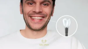 mini dental implants