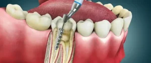 Root canal treatment