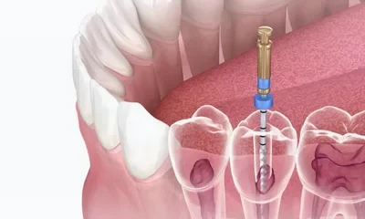 Root canal treatment