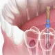 Root canal treatment
