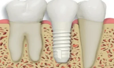 Zirconia Implants