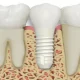 Zirconia Implants