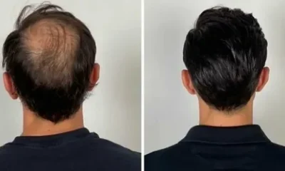 Hair Replacement