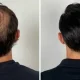Hair Replacement
