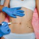 liposuction in Riyadh