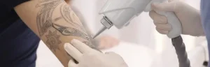 Laser Tattoo Removal