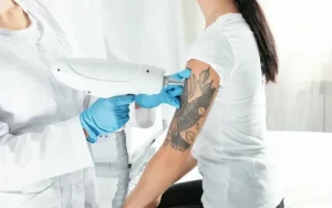 Laser Tattoo Removal