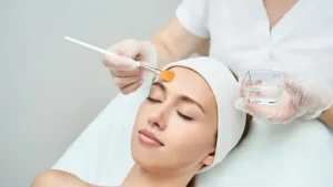 chemical peel
