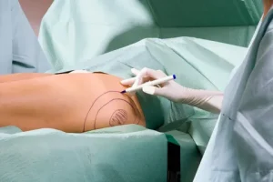 Liposuction in Dubai