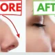 Rhinoplasty for Women