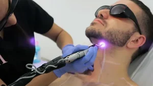 Laser Hair Removal for Men