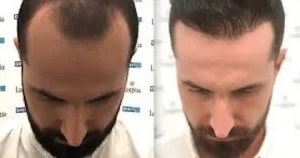 Hair Transplantation