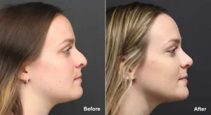 Corrective Rhinoplasty