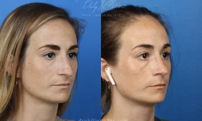Corrective Rhinoplasty