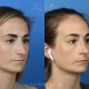 Corrective Rhinoplasty