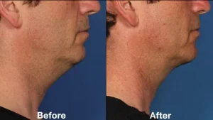 Chin Reduction