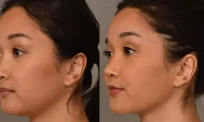 Chin Reduction