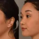Chin Reduction