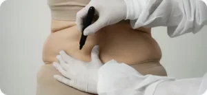 liposuction in Riyadh