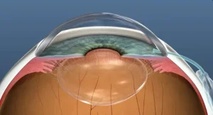 glaucoma drainage devices