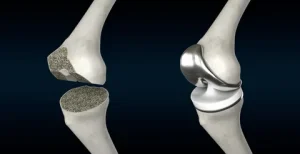 Total Knee Replacement (TKR)