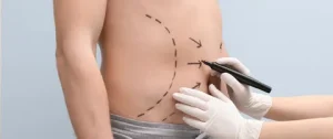 Liposuction