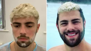 Beard hair transplant