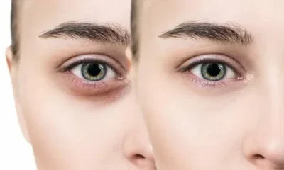Dark Circles Treatment