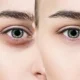 Dark Circles Treatment