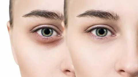 Dark Circles Treatment