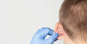 ear reshaping surgery