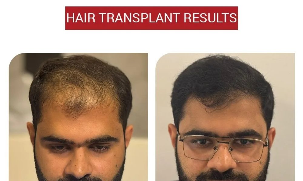 Hair Transplant