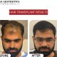 Hair Transplant