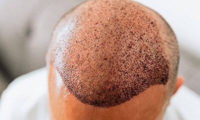 Hair Transplant