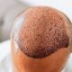 Hair Transplant