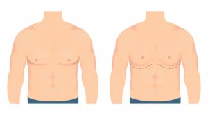 Gynecomastia