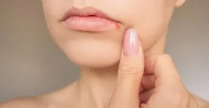 Lip Rash