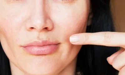 Lip Rash