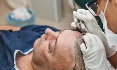 Beard Hair Transplant