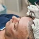 Beard Hair Transplant